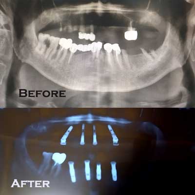 Dental Implants 4